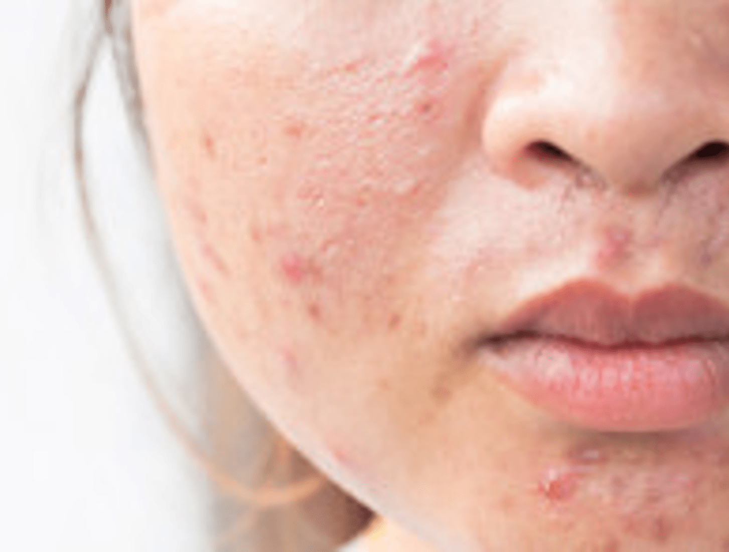 Acne Causes & Solutions Osprey Observer